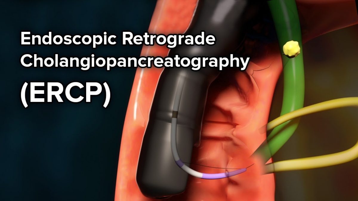 endoscopic retrograde cholangiopancreatography ercp
